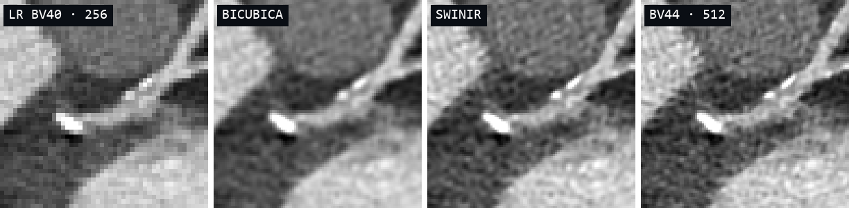 Calcificazioni coronariche: LR Bv40 a 256, bicubica, SwinIR e Bv44 a 512