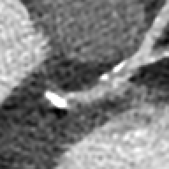 SwinIR — Calcificazioni coronariche, slice 264, W800 L200, 40 × 40 mm.