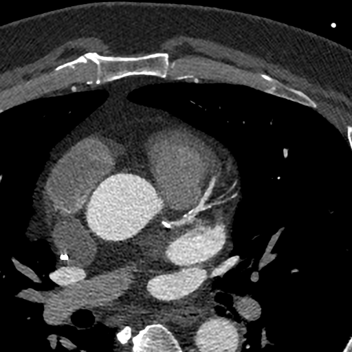 SwinIR — Slice 264 di un paziente di test, finestra W800 L200. Entrambi i metodi partono dalla stessa immagine Bv40 a 256 × 256 e arrivano a 512 × 512.